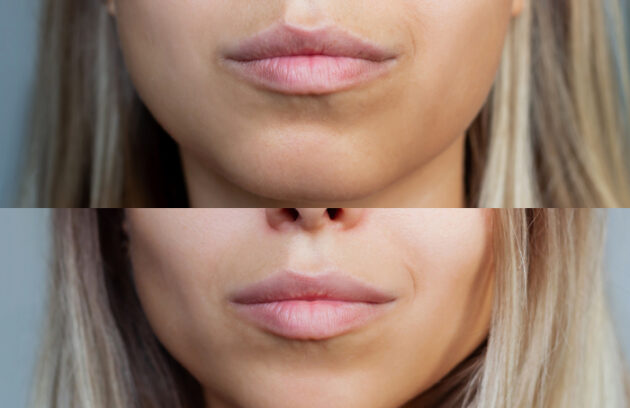 Medi Transformation Chin Reduction Woman S Face With Jaws Chin Before After Mentoplasty Surgerys