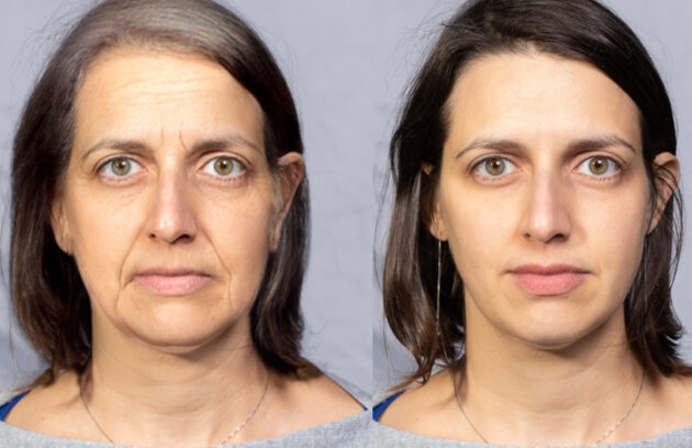 Medi Transformation Faces Process Aging Rejuvenation