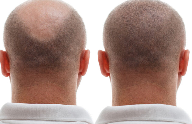 Medi Transformation Head Balding Man Before After Hair Transplant Surgery Man Losing His Hair Has Becomes