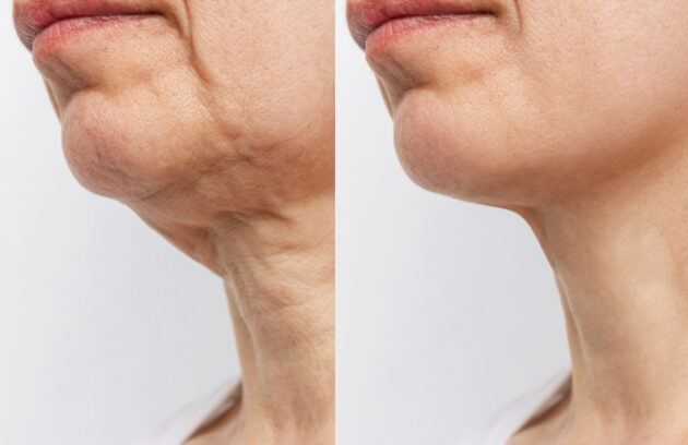 Medi Transformation Lower Part Face Neck Elderly Woman With Signs Skin Aging Before After Facelift