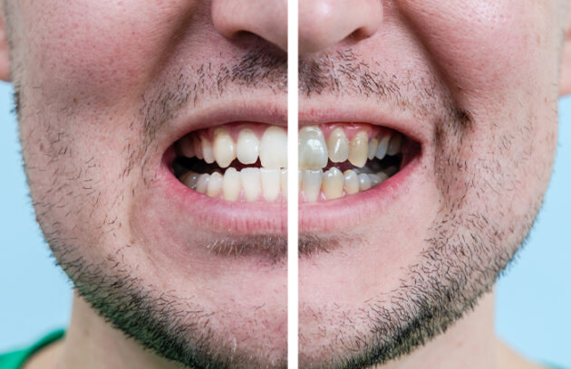 Medi Transformation Man Teeth Before After Whitening Dentist Work