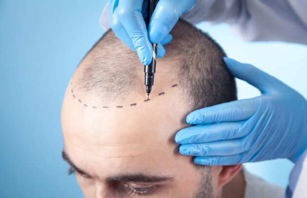 Medi Transformation Patient Suffering From Hair Loss In Consultation With A Doctor.