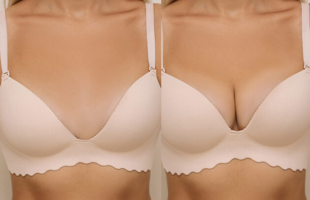 Medi Transformation Young Woman Bra Before After Breast Augmentation With Silicone Implants