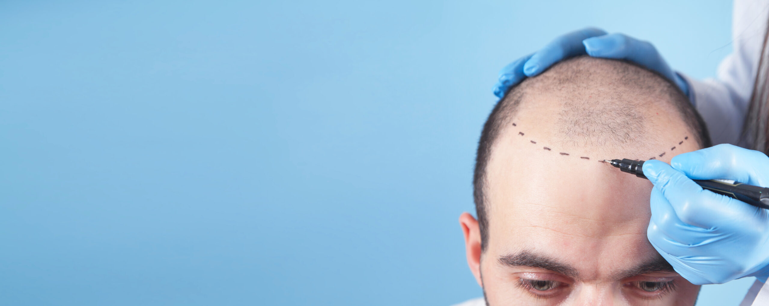 Patient Suffering From Hair Loss In Consultation With A Doctor.