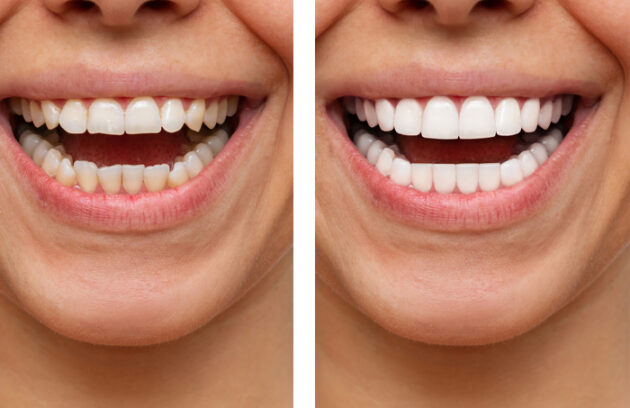 Medi Transformation Cropped Shot Young Caucasian Smiling Woman Before After Veneers Installation Comparisons